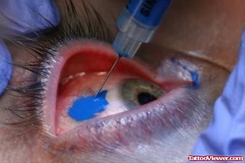 Eye Tattoo Colour Injection